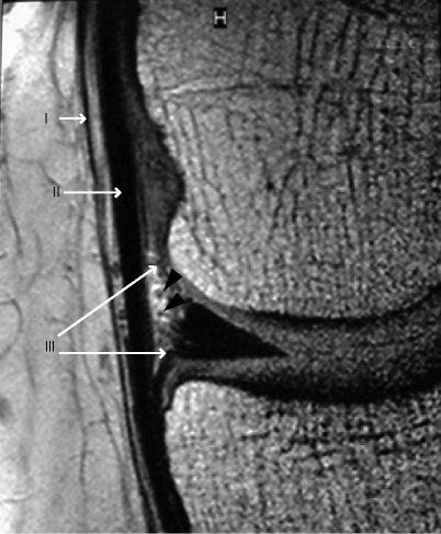 medial collateral ligament mri