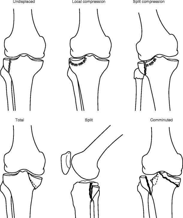 Fracture, Subluxation, and Muscle Injury | Radiology Key