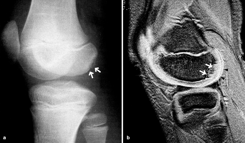 Pediatric And Adolescent Disorders Of The Knee Radiology Key