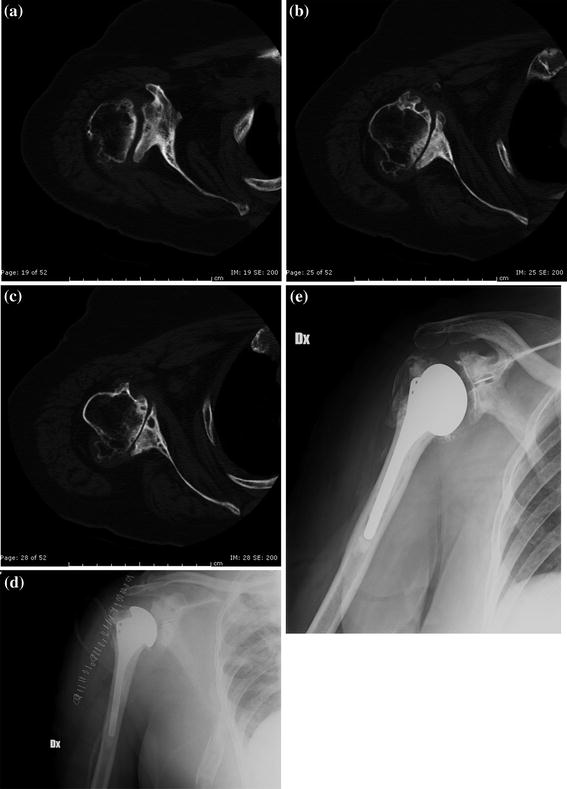 Shoulder | Radiology Key