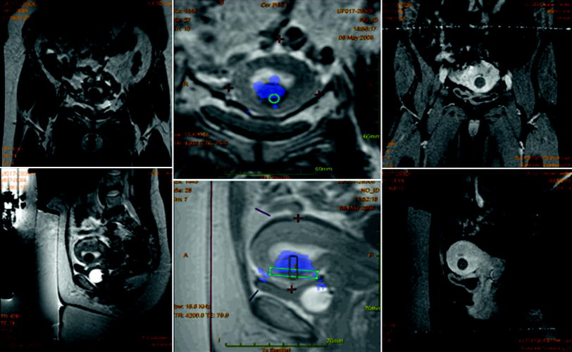 Role Of Magnetic Resonance Guided Focused Ultrasound For Uterine