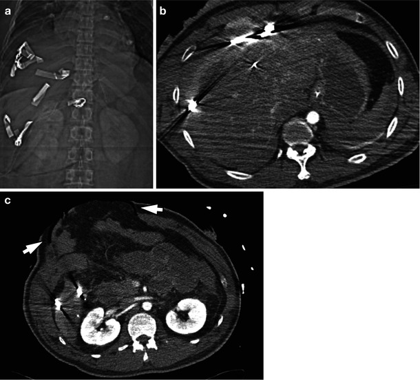 Trauma and Postoperative Changes of the Liver | Radiology Key