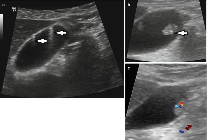 Tumors Of The Gallbladder Radiology Key