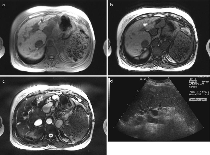 Diffuse Spleen Diseases Radiology Key