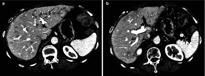 diffuse-liver-disease-radiology-key