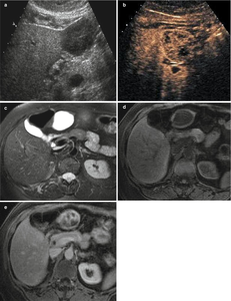 Benign Liver Tumors | Radiology Key