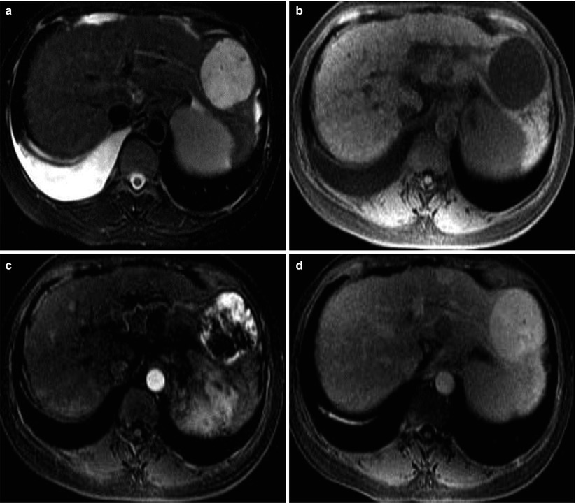 Benign Liver Tumors | Radiology Key