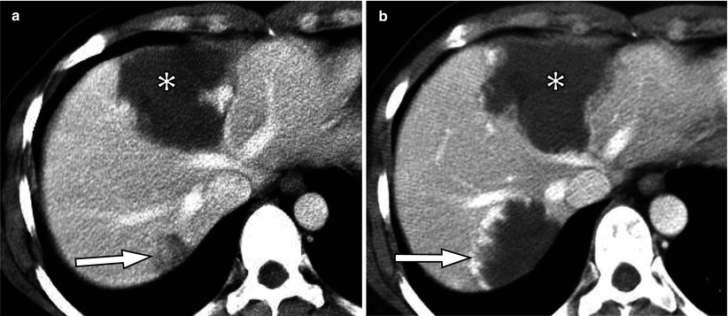 Benign Liver Tumors Radiology Key