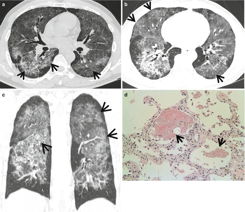 ground-glass-opacity-with-reticulation-radiology-key