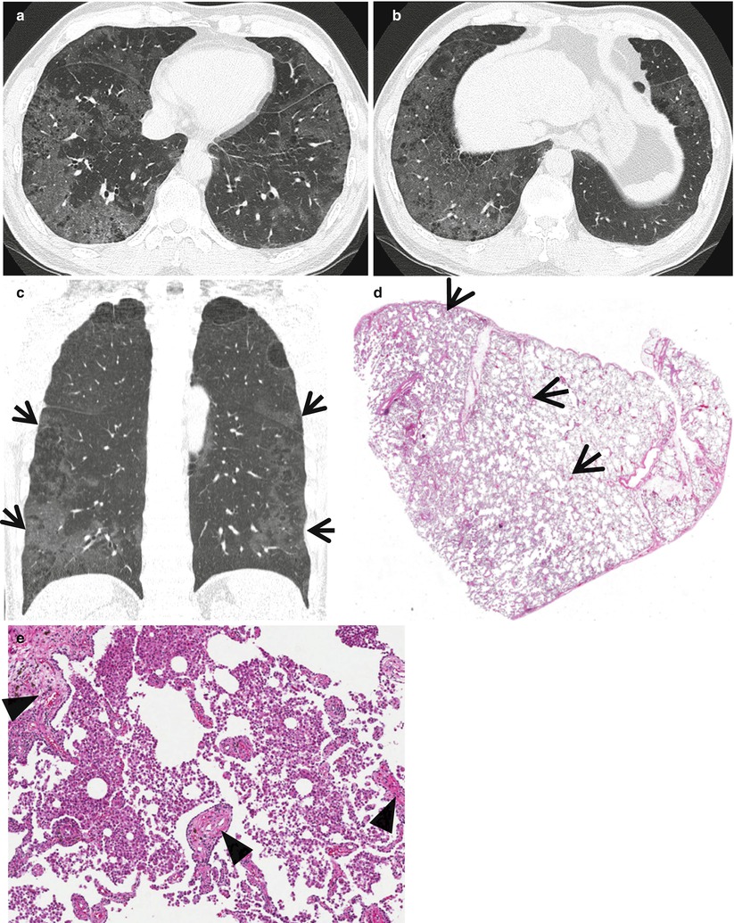 ground-glass-opacity-without-reticulation-radiology-key