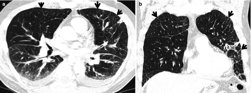 Ground-Glass Opacity Without Reticulation | Radiology Key