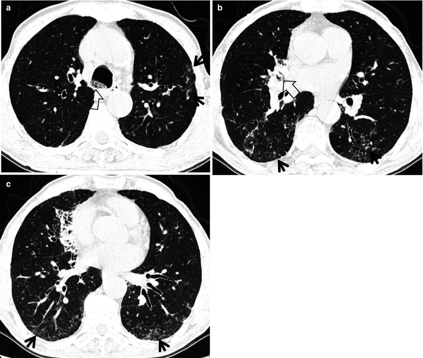 Tree In Bud Sign Radiology Key