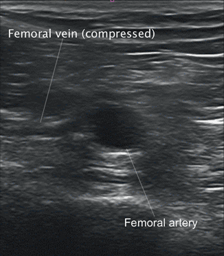 Vascular Ultrasound in the Critically Ill | Radiology Key