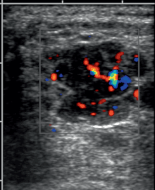 Inflammatory Allied Conditions | Radiology Key