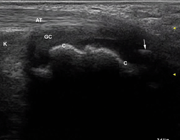 Pitfalls in Musculoskeletal Ultrasound | Radiology Key