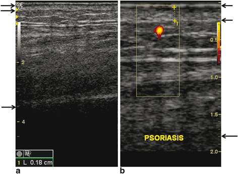 Psoriatic Arthritis | Radiology Key