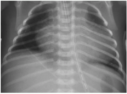 Complex Cyanotic Congenital Heart Disease | Radiology Key