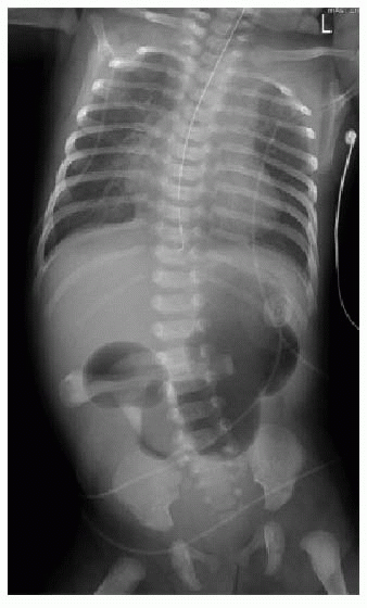 Upper Gastrointestinal Obstruction | Radiology Key