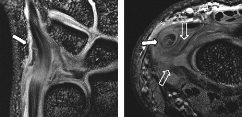 Wrist Ligaments and the Triangular Fibrocartilage Complex | Radiology Key