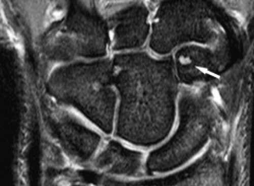 Miscellaneous Conditions Of The Wrist | Radiology Key