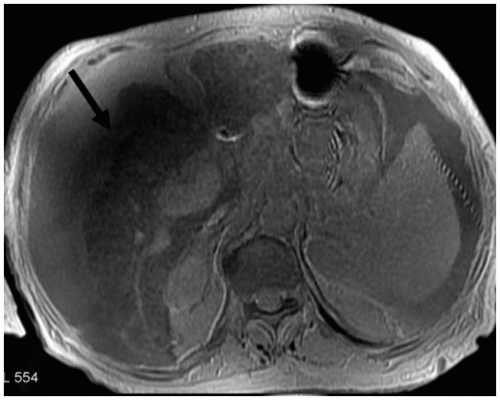 Wrap-around artifact - Questions and Answers ​in MRI