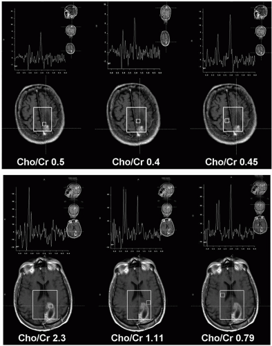 mr-spectroscopy-in-the-brain-radiology-key