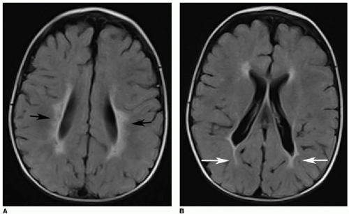 Vascular And Traumatic Brain Injury Radiology Key