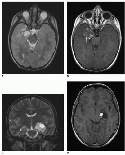 Chumado Brain Tumor Headache Pattern