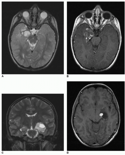 Brain Tumors | Radiology Key