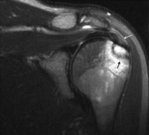Rotator cuff tear, Radiology Reference Article