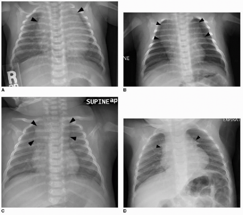 theRadiologist on X: ANATOMY: Chest X-Ray fused with coronal CT showing  mediastinal anatomy  / X