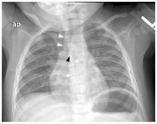 a) A 12-year-old boy presented with a large chest wall mass, later