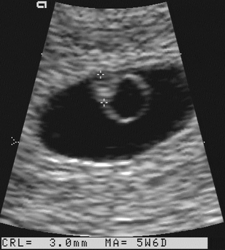 yolk sac 6 weeks