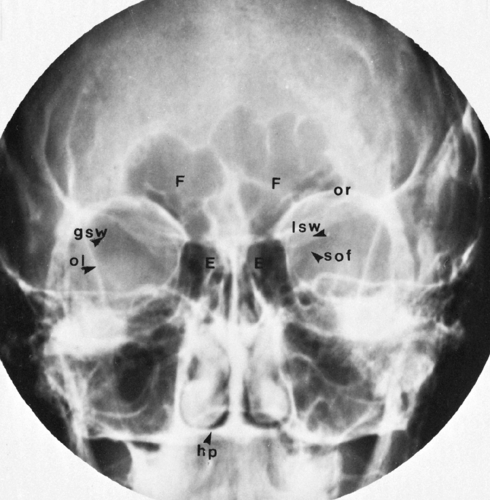 The Paranasal Sinuses Radiology Key