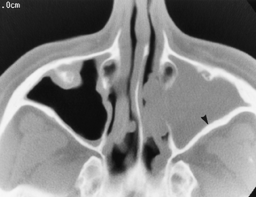 The Paranasal Sinuses | Radiology Key