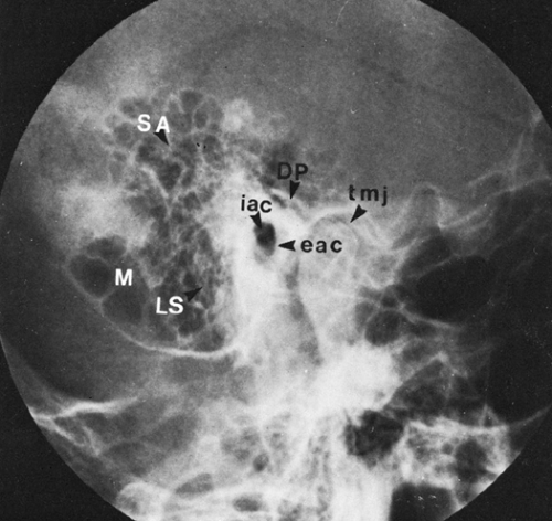 mastoid air cells x ray