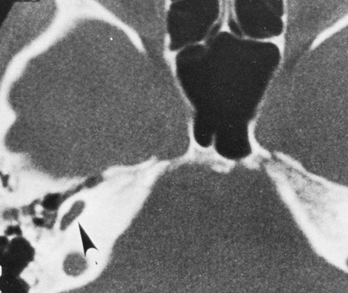 The Temporal Bone Radiology Key