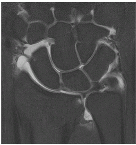 Wrist | Radiology Key