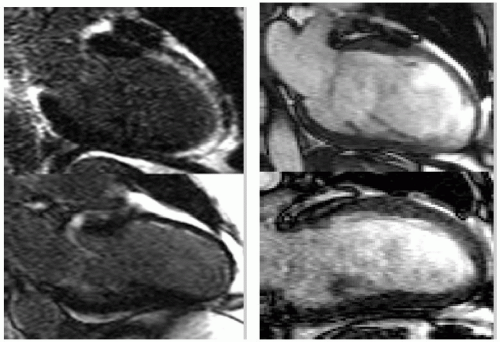 Myocardial Perfusion and Viability | Radiology Key