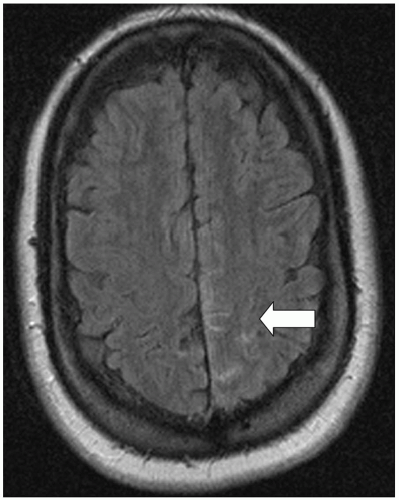 Subarachnoid Hemorrhage Radiology Key