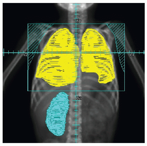 Wilms Tumor | Radiology Key