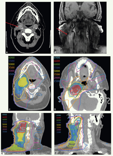 Treatment of Local-Regional Recurrence | Radiology Key