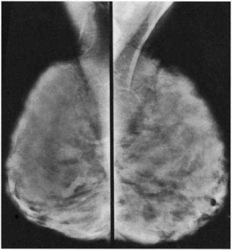 Breast disease in the pregnant and lactating patient: radiological