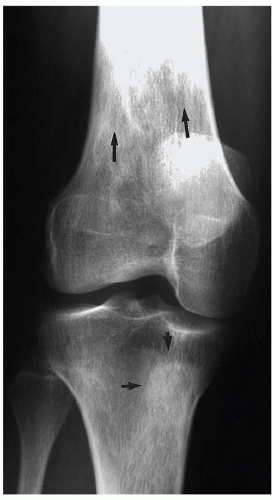 Lateral radiograph of the left tibia demonstrating the characteristic