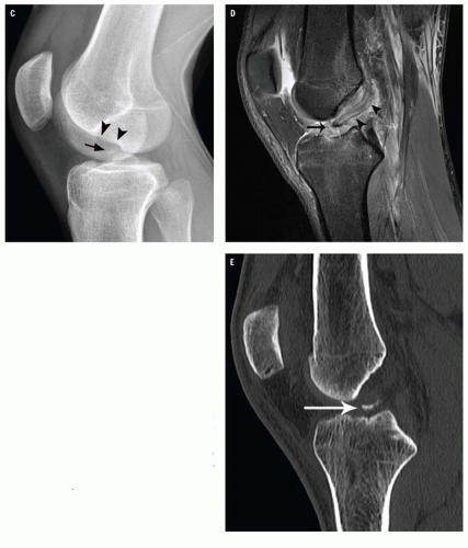 Lateral radiograph of the left tibia demonstrating the characteristic