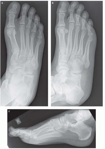 X-ray Image Broken Calcaneus Lateral Axial Stock Photo 269956943 |  Shutterstock
