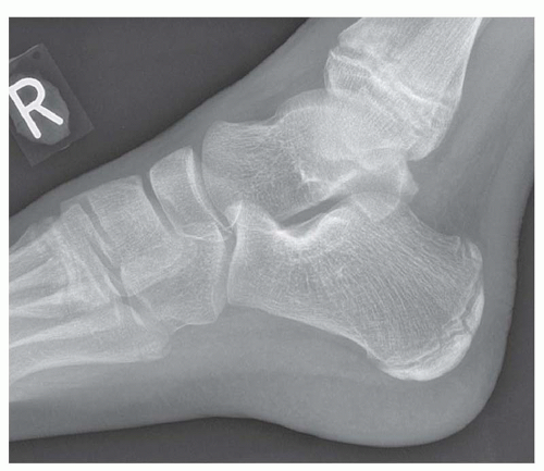 normal foot xray lateral