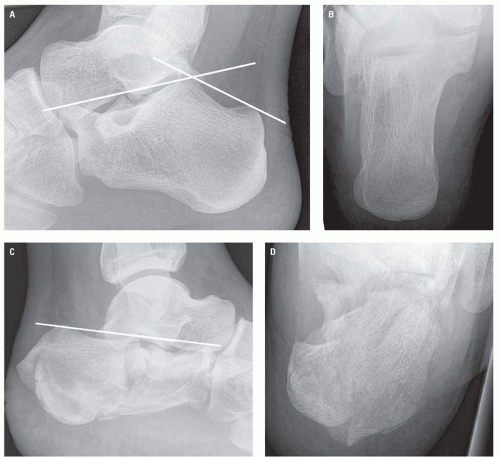 Normal lateral calcaneal radiography | Radiology Case | Radiopaedia.org