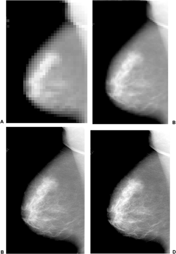 MAMMOGRAPHY  Radiology Key