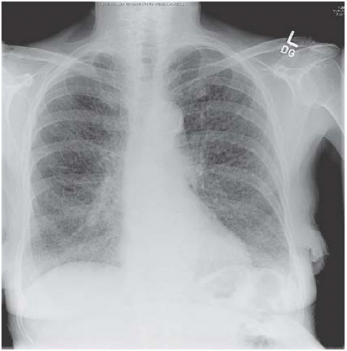 Consolidation, Collapse and Cavitation | Radiology Key